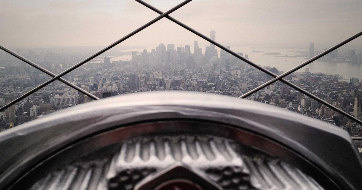 M字はげ 植毛 生え際