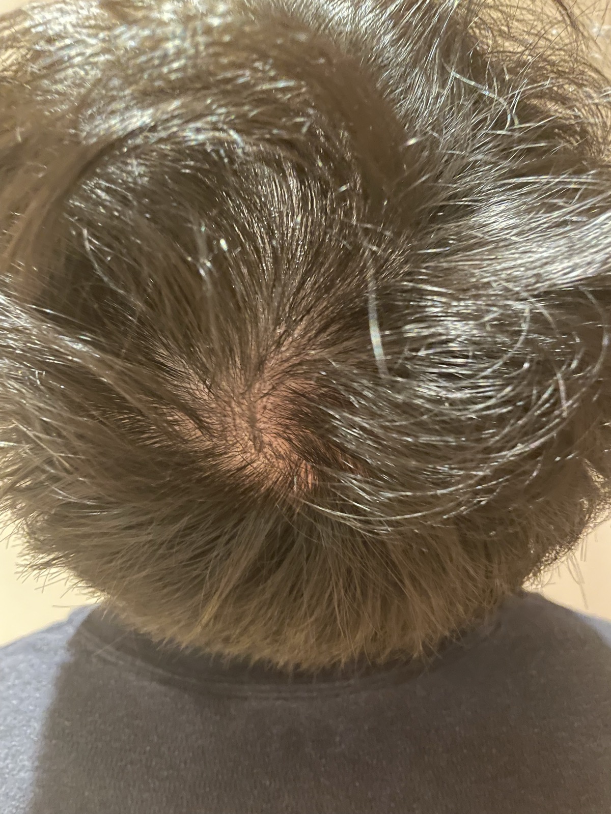 術後3ヶ月・つむじ周辺