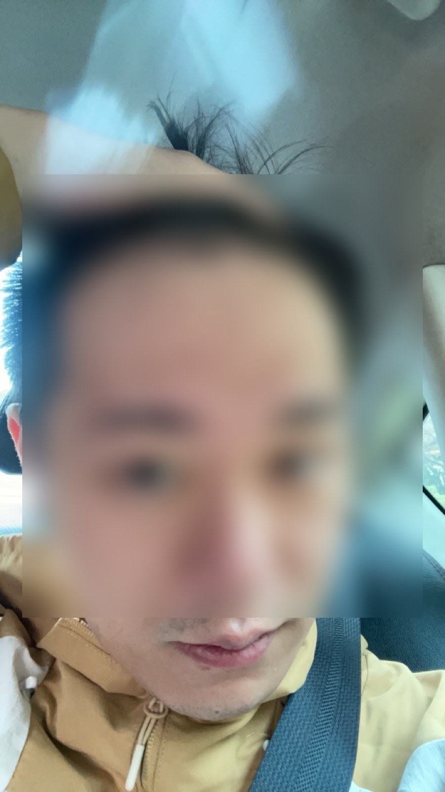 術後3ヶ月・発毛状況（顔ぼかし済み）