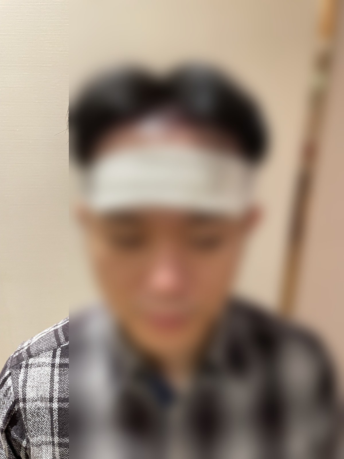 術後・包帯巻き正面（顔ぼかし済み）