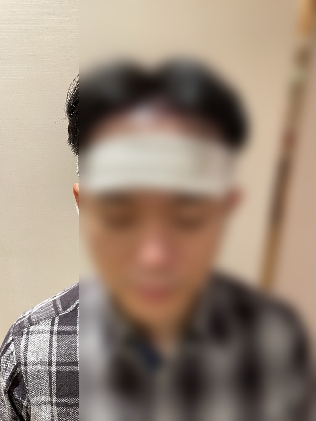 術後・包帯巻きサイド（顔ぼかし済み）