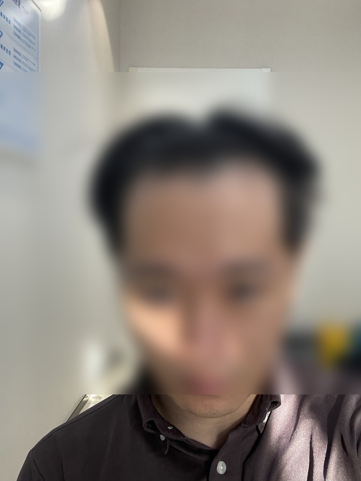 カウンセリング当日の薄毛状態（顔ぼかし済み）