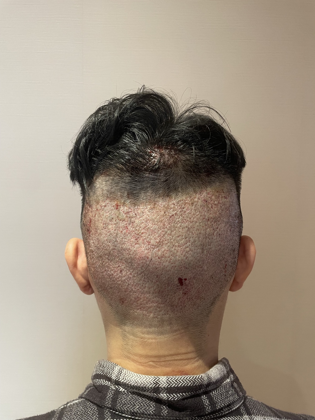 術後1日目・ドナー採取部（頭頂から）