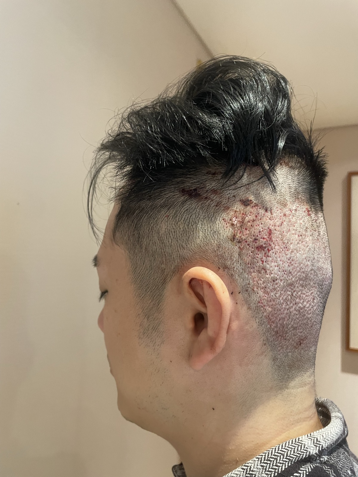 術後1日目・側面