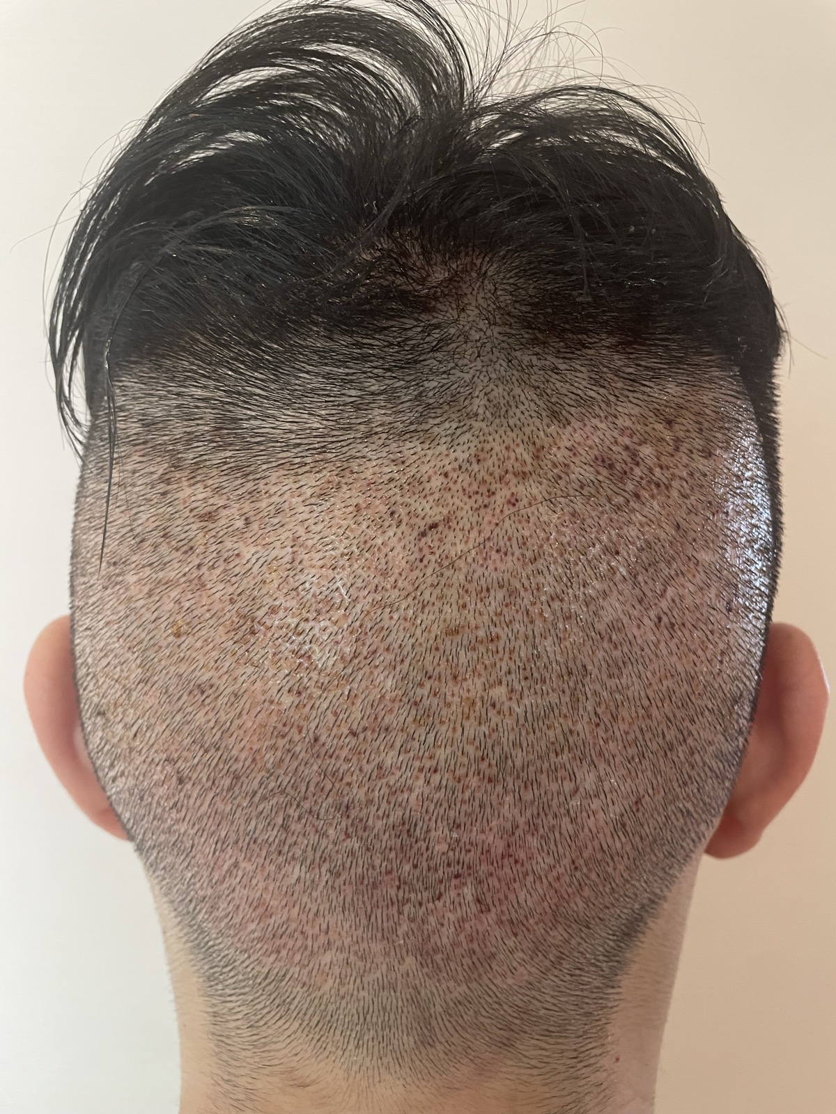 術後2日目・ドナー部（後頭部）