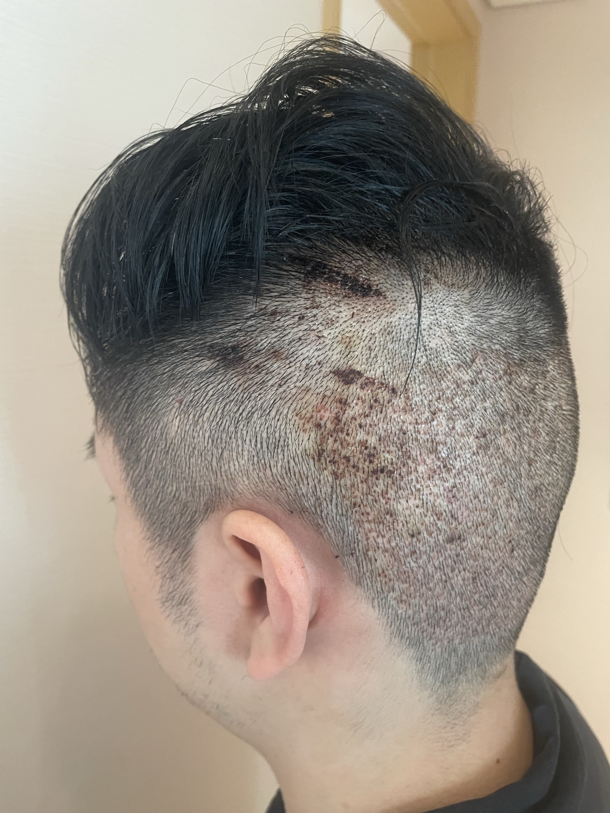 術後3日目・側面（移植エリア）