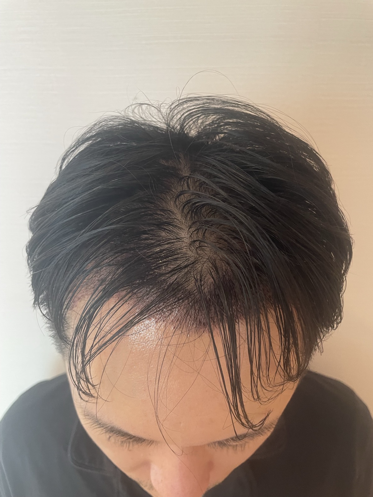 術後3日目・頭頂部