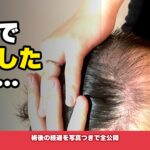 【2024年実体験】中国植毛の費用・クリニック・手術の流れを完全解説｜雍禾医療集団での植毛体験記