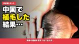 【2024年実体験】中国植毛の費用・クリニック・手術の流れを完全解説｜雍禾医療集団での植毛体験記