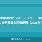 M字植毛のビフォーアフター｜実際の症例写真と回復経過【2026年】