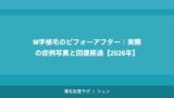 M字植毛のビフォーアフター｜実際の症例写真と回復経過【2026年】