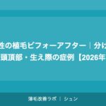 女性の植毛ビフォーアフター｜分け目・頭頂部・生え際の症例【2026年】