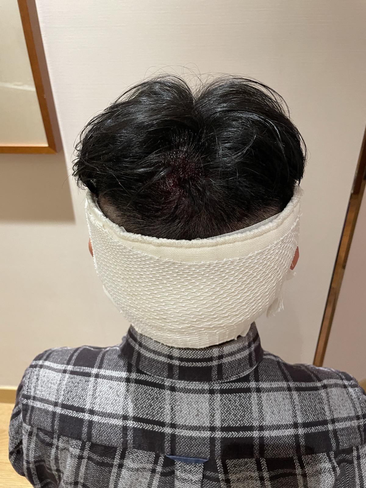 術後・包帯巻き後頭部