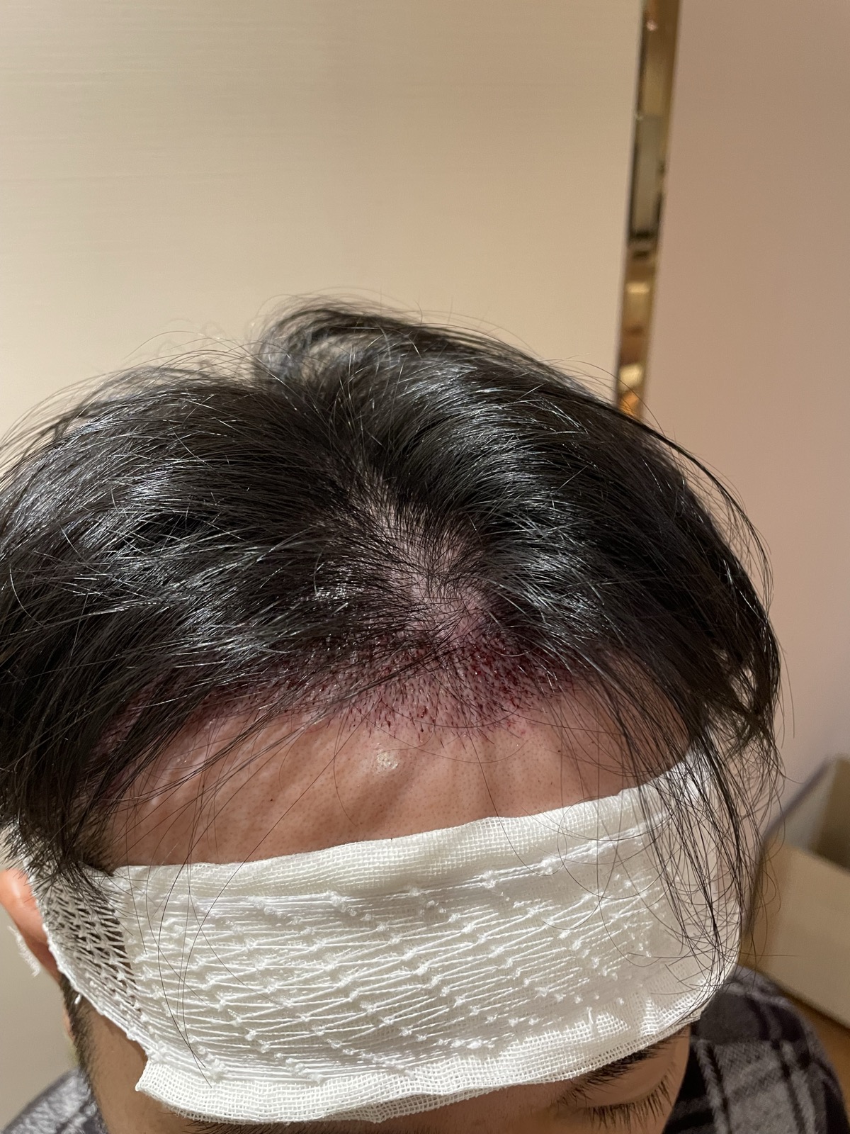 術後・頭頂部から見た包帯の状態