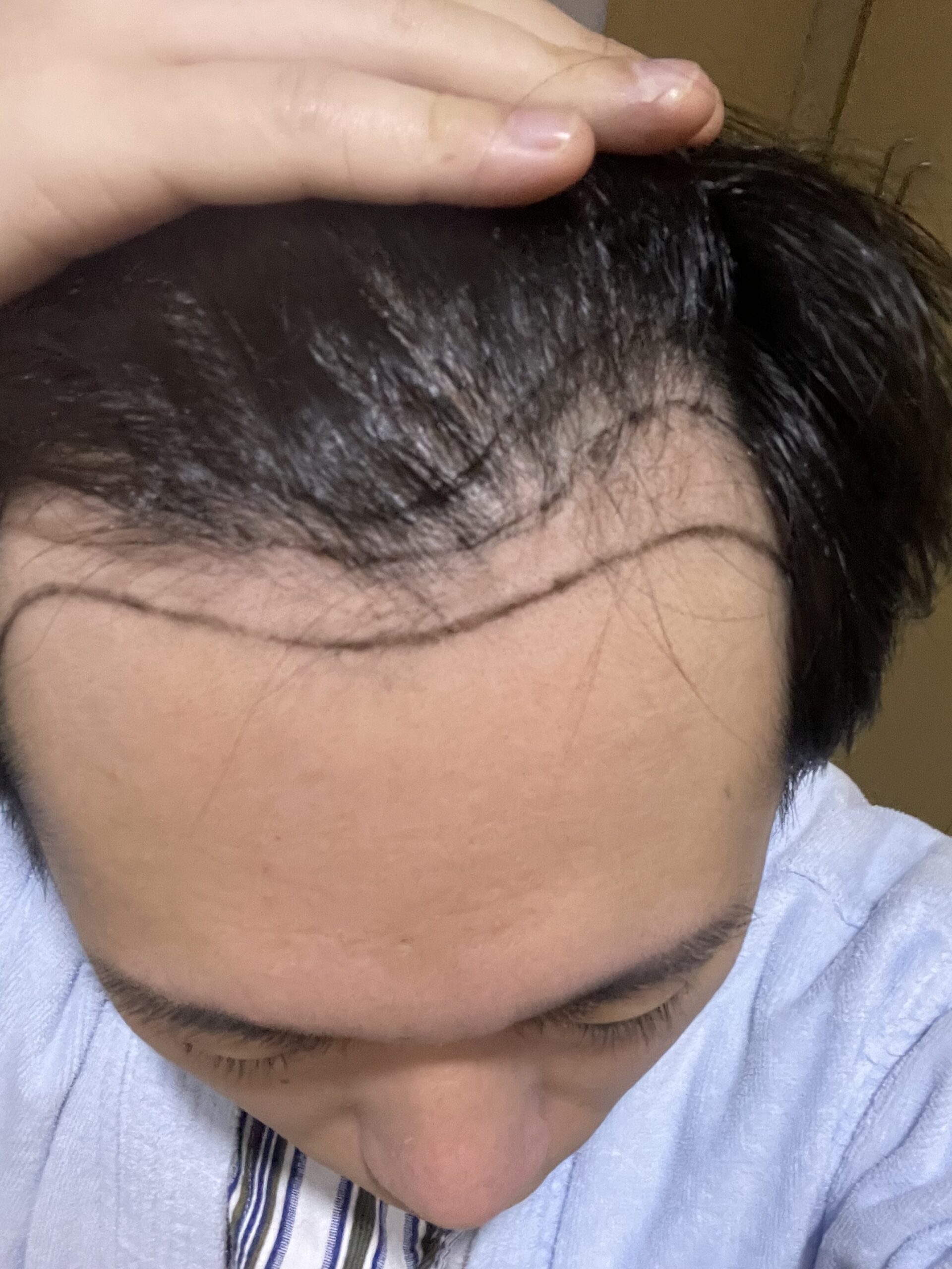 術前のデザインライン