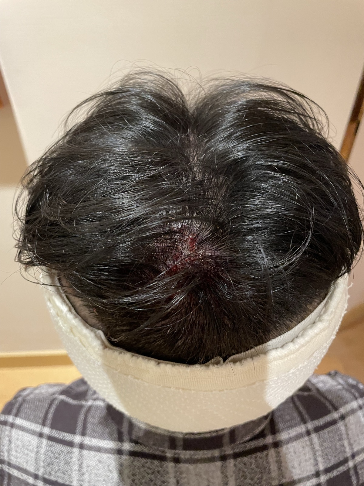 術後当日夜・移植エリアの頭頂部