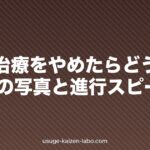 AGA治療をやめたらどうなる?1年後の写真と進行スピード
