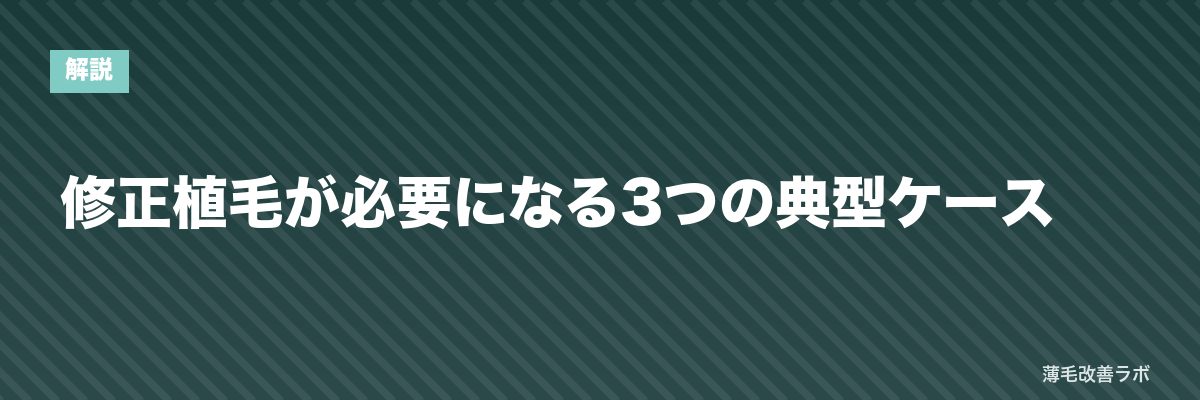 修正植毛が必要になる3つの典型ケース | 薄毛改善ラボ