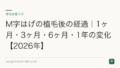 M字はげの植毛後の経過|1ヶ月・3ヶ月・6ヶ月・1年の変化【2026年】