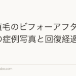 M字植毛のビフォーアフター｜実際の症例写真と回復経過【2026年】