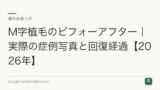 M字植毛のビフォーアフター｜実際の症例写真と回復経過【2026年】
