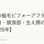 女性の植毛ビフォーアフター｜分け目・頭頂部・生え際の症例【2026年】