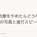 AGA治療をやめたらどうなる？1年後の写真と進行スピード